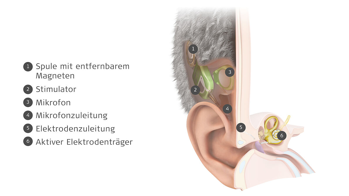 MED-EL präsentiert TICI UNICO